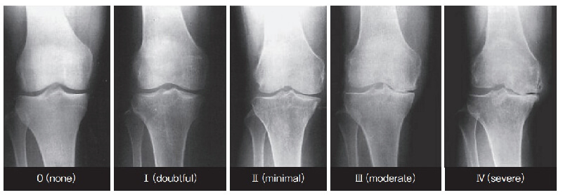 変形性膝関節症の進行度